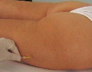 Carbossiterapia, trattamento della cellulite e delle adiposità localizzate
