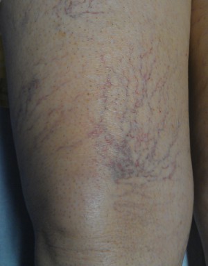 Laser e Scleroterapia per il trattamento di varici e teleangectasie capillari